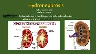 Hydronephrosis( Definition, causes and etiology, pathology, types, diagnosis, treatment).