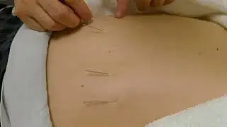 belly needle