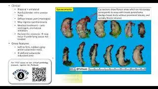 Breast (Male): Gynaecomastia (Gross pathology)