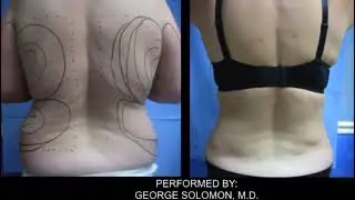 Liposuction of The Back: Before and After #BackLiposuction