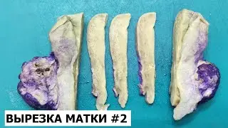 Гистологическое исследование (вырезка) матки #2 - рак эндометрия