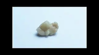 ¿Cómo evitar los tonsilolitos?