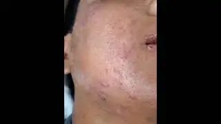 Acne Treatment peeling + ozone therapy #acne #acnetreatment #ozonetherapy #deepcleaning #skin