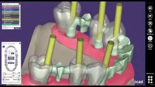 exocad Видео урок передовые виртуальные десны и дизайн цифровой Waxup