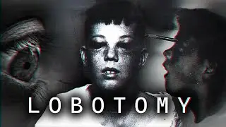 The Lobotomy: Darkest Surgery In History