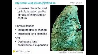 Solitary Pulmonary Nodule and Interstitial Lung Disease... Chapter 7