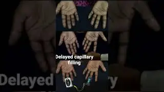 Demonstration of delayed capillary refilling