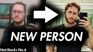 Post Breakup Motivation: Hair Loss Recovery & Gym | Hairloss Stack Podcast No.6
