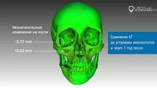 Атрофия кости при установке лицевых имплантатов.