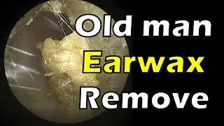 Old man Earwax Removal
