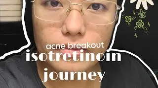 Severe Acne • isotretinoin journey for 2 months #acnetreatment