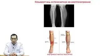 Переломы диафиза кости конечностей