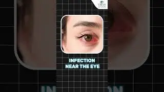 Safe Eye Makeup After LASIK Surgery | Tips for Safe Eye Makeup After LASIK Surgery
