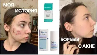 акне: моя история/эффезел спас мою кожу