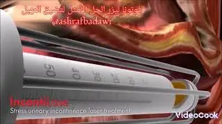 فوتونا ليزر الحل الأمثل لتضيق المهبل