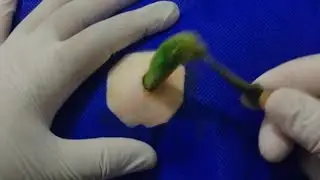 Treatment Of Blackhead Removal at Lam Dep Spa #041