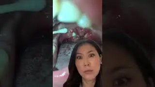Huge tonsil stone pops right out! 