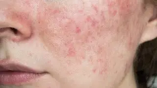 РОЗАЦЕА и другие болезни тела