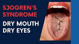 Sjogren's Syndrome - Dry Eyes, Dry Mouth HELPED by Dr Suh Chiropractic