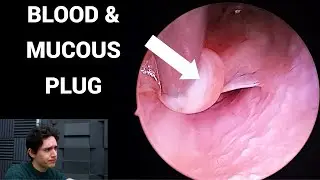 Mucous Plug Blocking Ear Canal (Tweezers Eardrum Perforation)