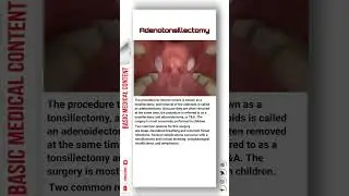 Adenotonsillectomy 