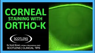 Scotlens series | Topography Tips | Ortho-k Corneal Staining