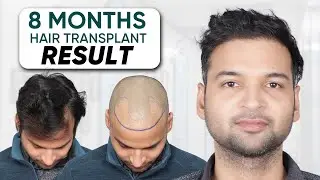 Hair Transplant in Trichy | Best Results & Cost of Hair Transplant in Trichy