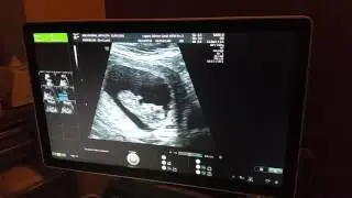 Ultrasound of Baby KIAN