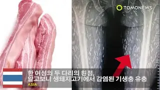 한 여성의 두 다리의 흰점, 알고보니 생돼지고기에서 감염된 기생충 유충