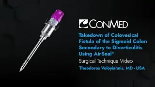 Takedown of Colovesical Fistula of Sigmoid Colon Using AirSeal® - Theodoros Voloyiannis, MD - CONMED