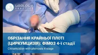 Циркумцизія: фімоз 4-ї стадії / Циркумцизия: фимоз 4-й стадии / Circumcision with phimosis 4 stage