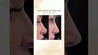 Non-Surgical Nose Job
