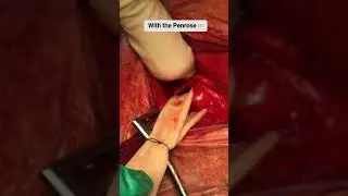 Hybrid Robotic-Assisted Tracheoesophageal Fistula Repair 