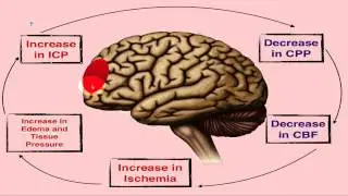 Increased Intracranial Pressure - ICP - EMTprep.com