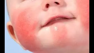 Диатез у ребенка. Симптомы.Лечение в домашних условиях.