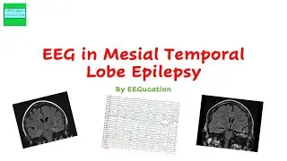 EEG in Mesial Temporal Lobe Epilepsy