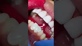 Step-by-Step Veneer Application Process