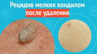 🤨 Рецидив мелких кондилом после удаления. Клинический случай №1230