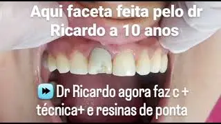 Faceta de resina encobre dente escuro sim