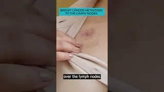 Spotting Symptoms of Breast Cancer Metastasis to Lymph Nodes 🎗️🔍