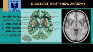 MRI Brain anatomy - Basal ganglia