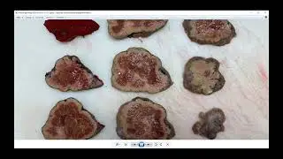 Очаговая узловая (фокальная нодулярная)  гиперплазия печени