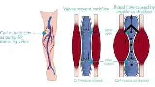 Soleus Muscle | Trigger Point Anatomy | Referred Pain