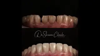 Smile Makeover with Ceramic Veneers