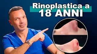 Rhinoplasty at 18: How Does It Work? What to Expect? (Vlog 05)