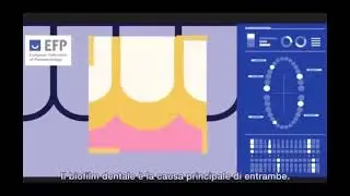 🟢 Malattie Parodontali e carie | Paolo Levis New Dental Care