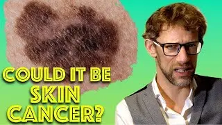 How To Check For Melanoma In 5 Easy Steps - Skin Cancer Assessment - Dr Gill
