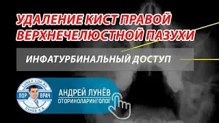 Удаление кист правой верхнечелюстной пазухи. Инфратурбинальный доступ.