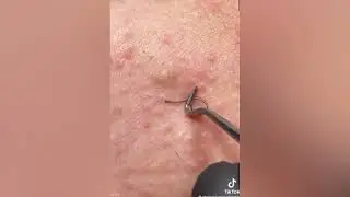 Blackhead King, All Star Medical, Caroline Popper and World's Greatest Medical