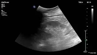 УЗИ правой почки. Злокачественная опухоль правой почки.. Ultrasound diagnostics. Kidney. Cancer.